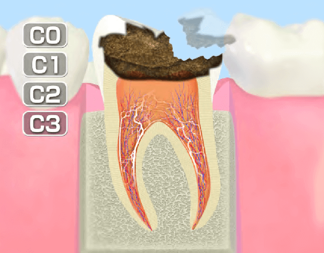 歯髄まで進行したむし歯 (C3)
